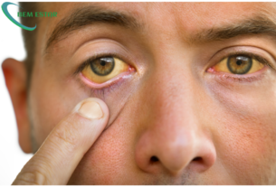 insuficiência hepática aguda, doença hepática, fígado, hepatite, cirrose, transplante hepático, bilirrubina, encefalopatia hepática, colestase, sintomas de insuficiência hepática